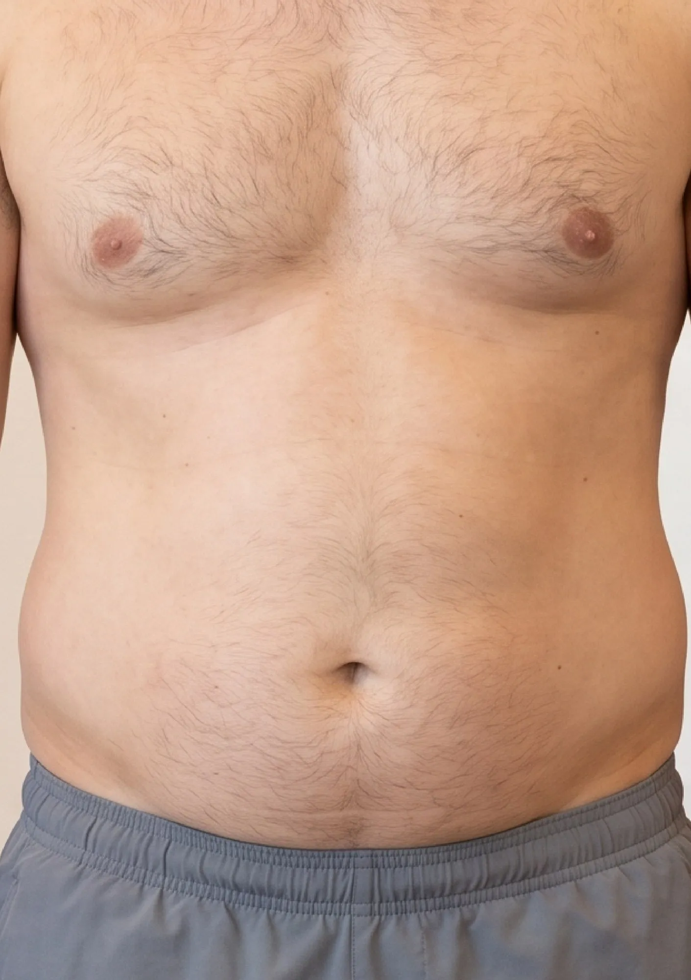 Before Liposuction