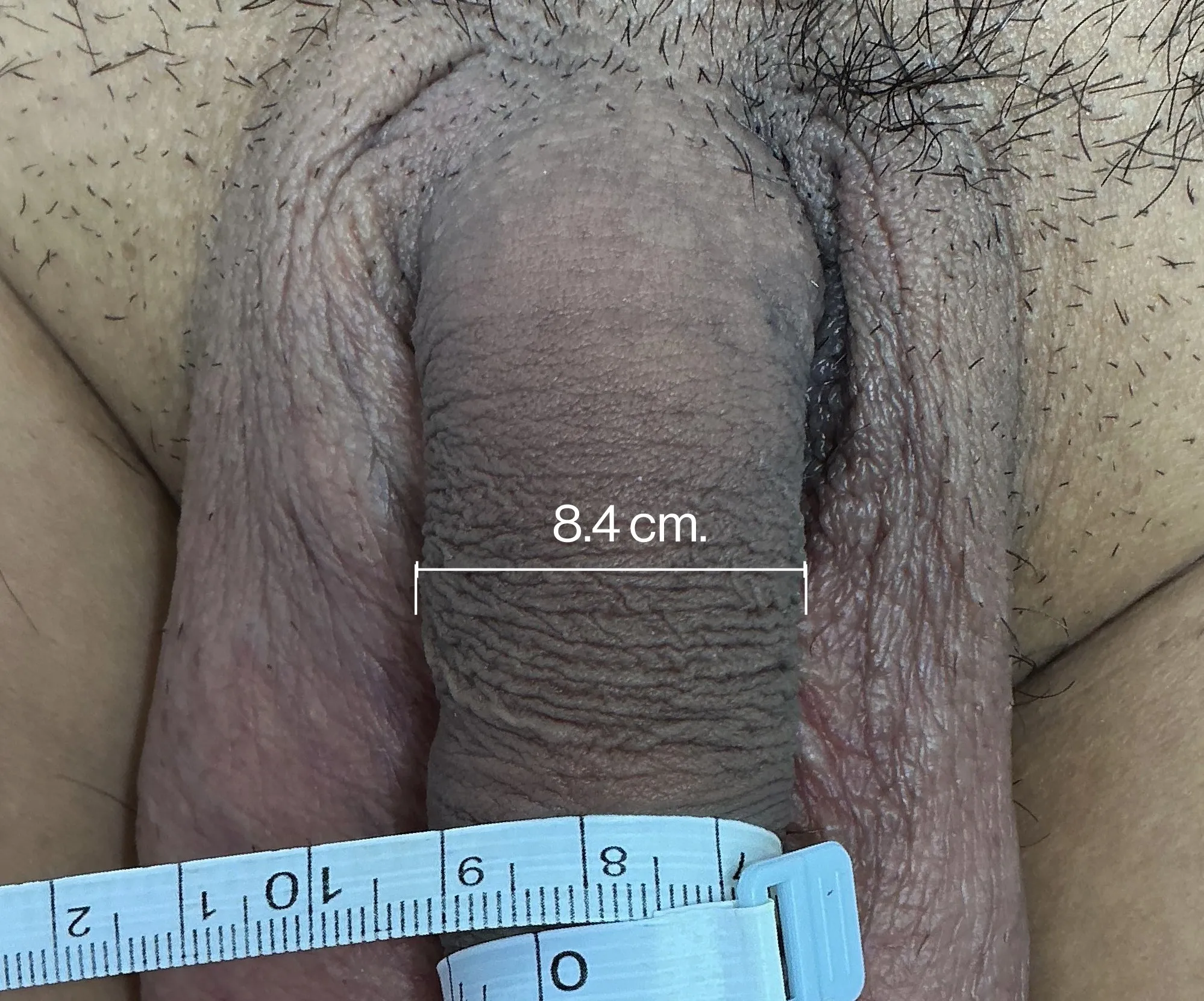 Before Penile Filler