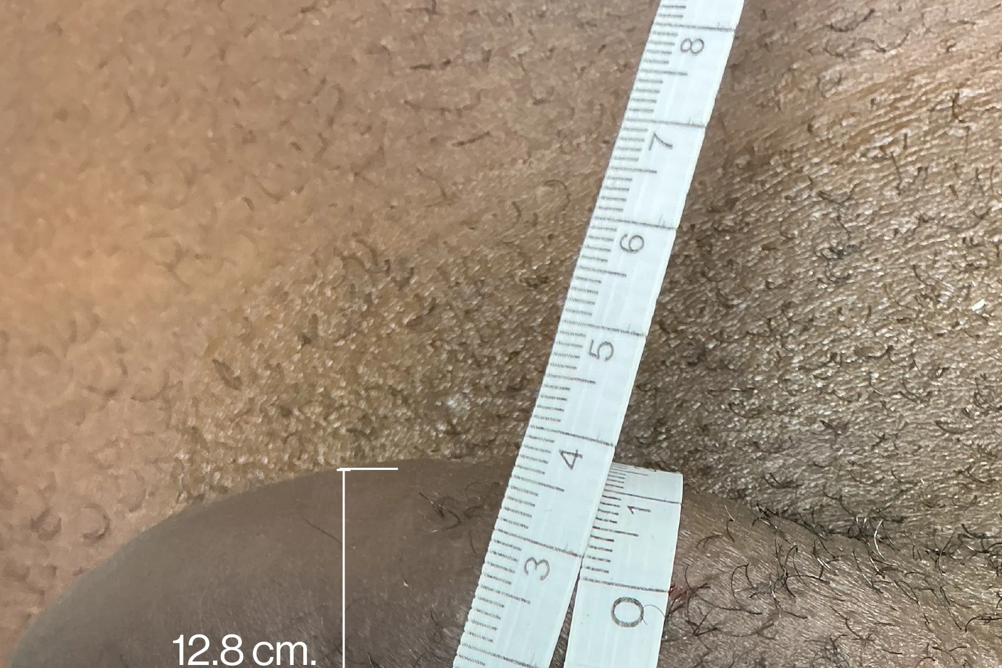 After Penile Filler