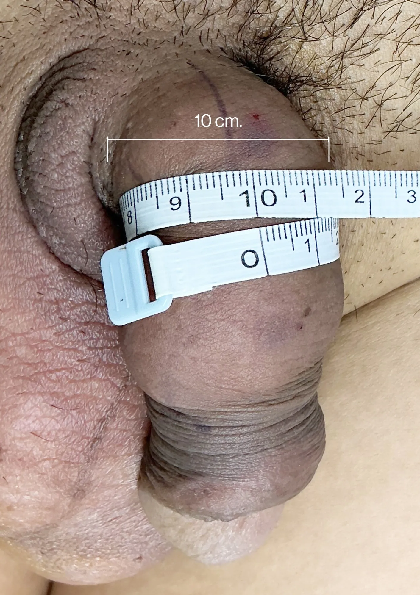 After Penile Filler