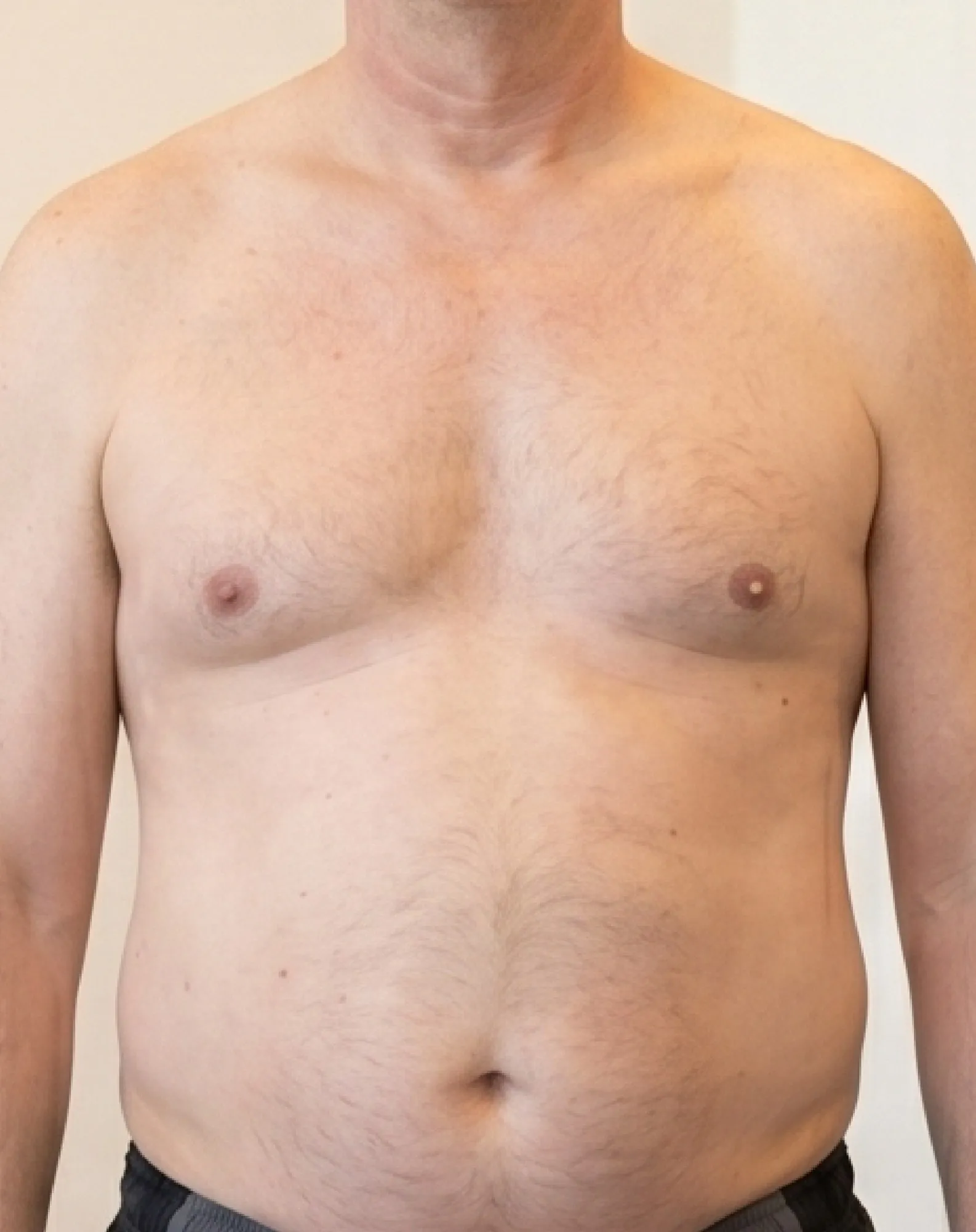 Before Liposuction