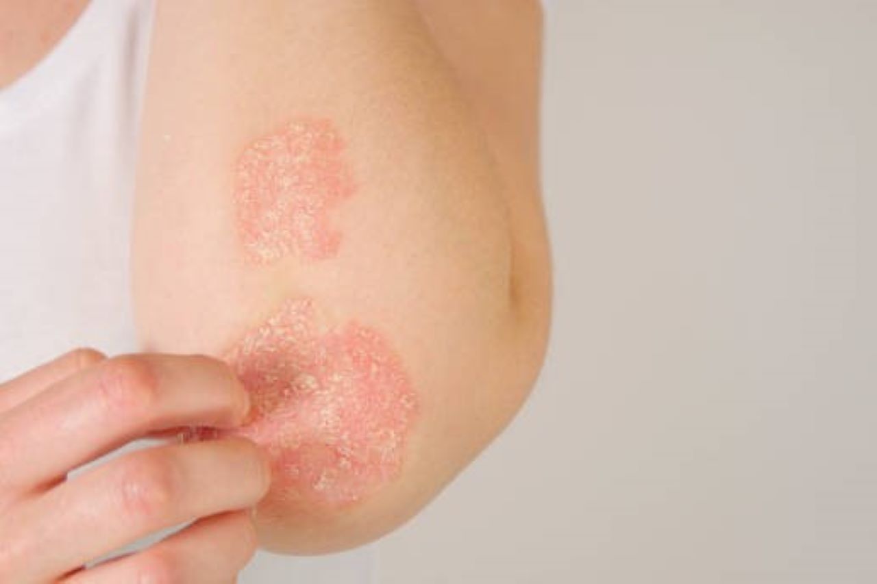 Psoriasis plaques