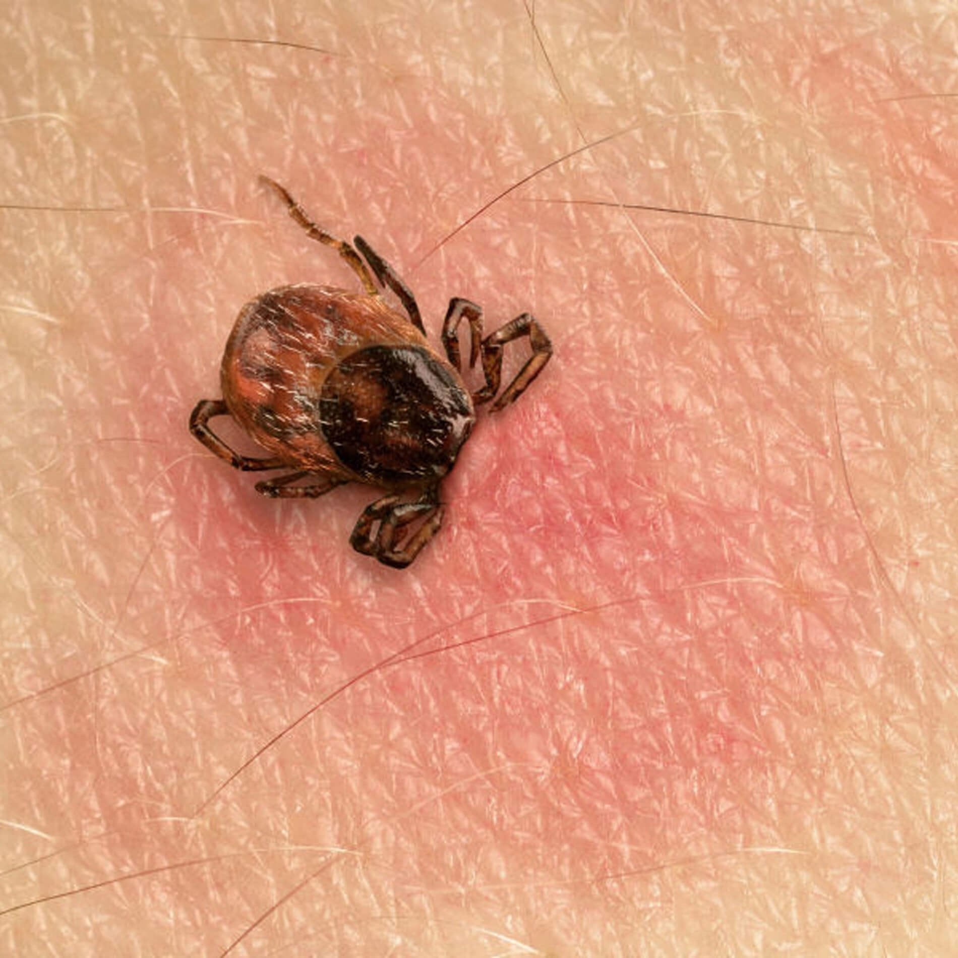 Close-up of a tick embedded in human skin, surrounded by a red, irritated area.