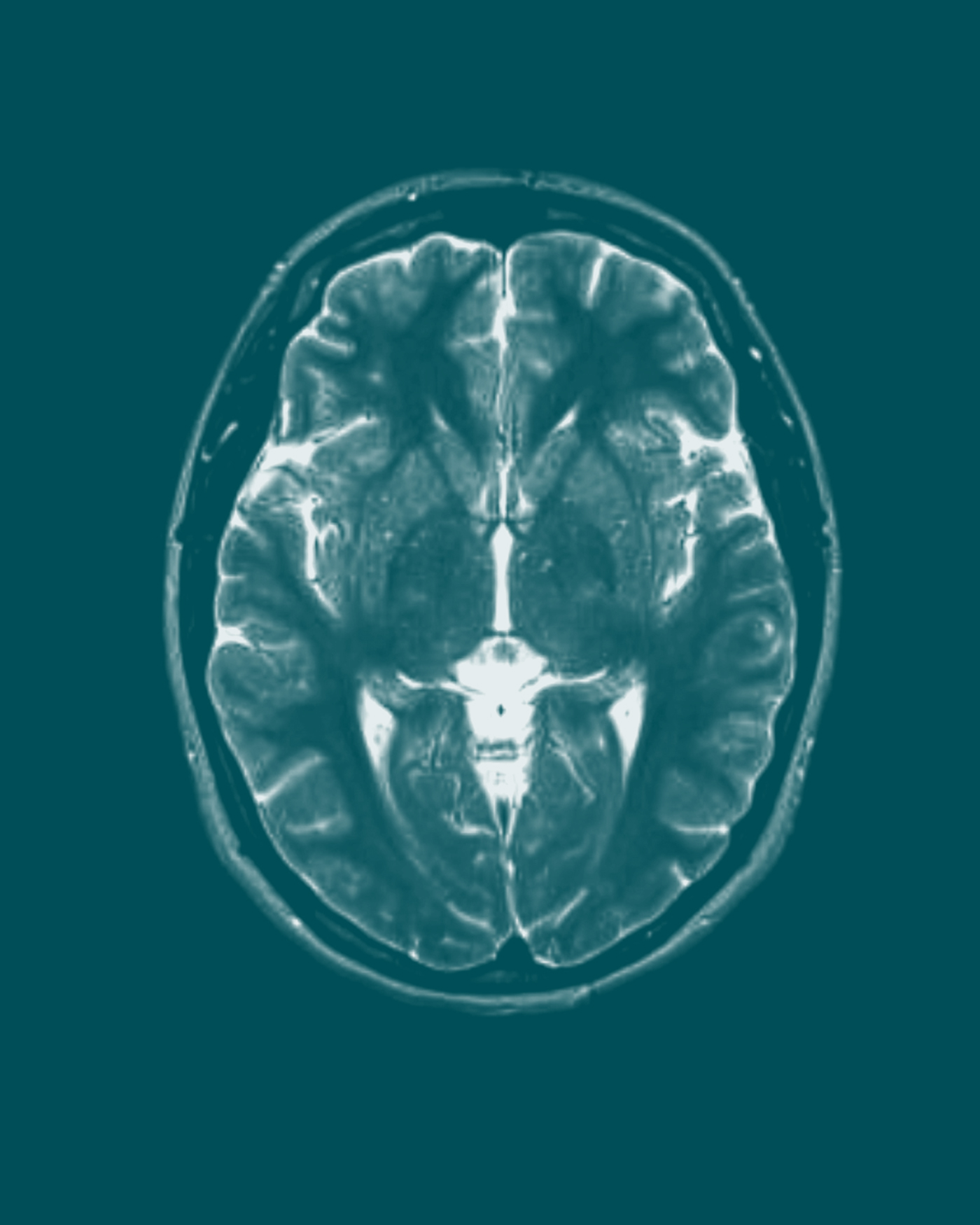 MRI scan of a human brain, showing detailed cross-sectional view with symmetrical structures on a teal background.