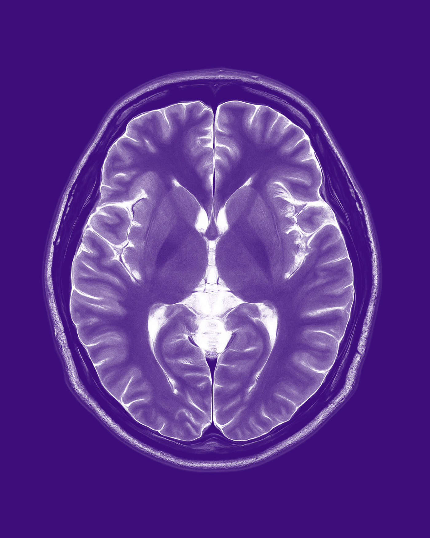 MRI scan of a human brain in purple tones, showing symmetrical structures, white matter, and detailed contours.