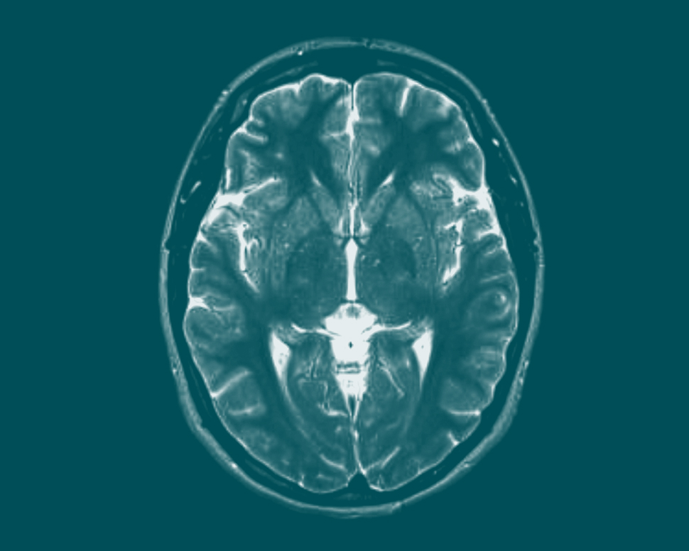 MRI scan of a human brain, showing detailed cross-sectional view with distinct white and gray matter on a teal background.