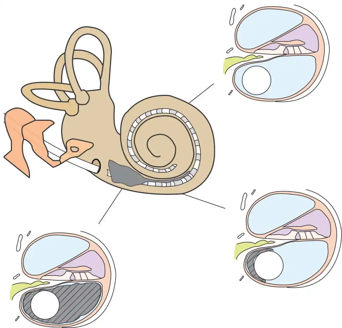 New Bone Formation (NBF) is shown (gray) inside the cochlea, developing alongside the electrode array (stripes). Image courtesy the Radiological Society of North America.