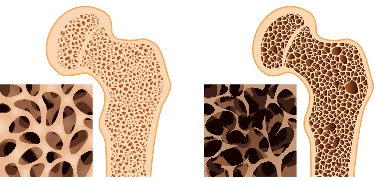 Normaler Knochen versus Osteoporose