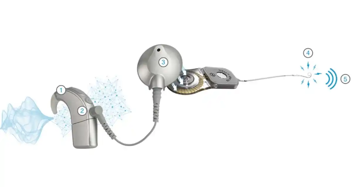 Cochlear Implant