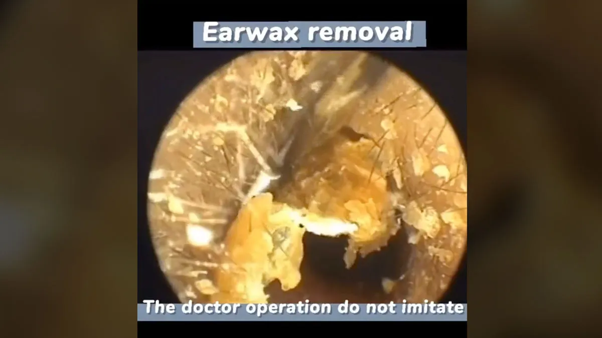 Earwax Removal