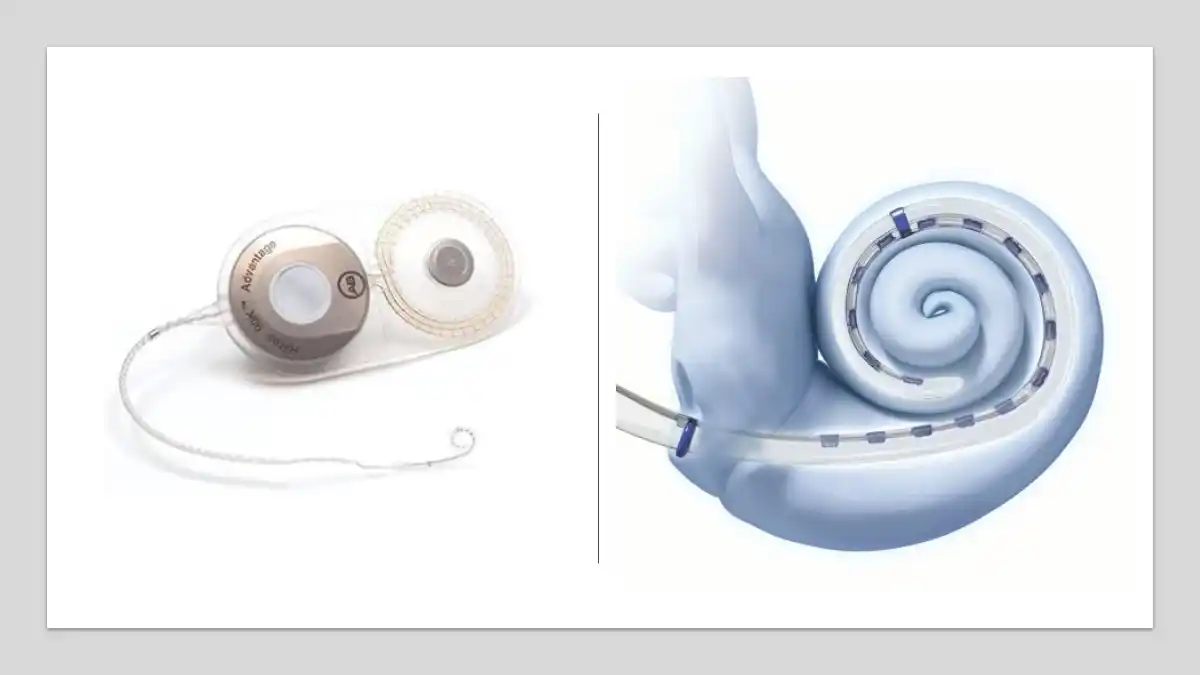 The Advanced Bionics electrode (the tiny curled wire-like portion on the left) and a graphic demonstrating its insertion into the cochlea (right). AB offers 2 different electrodes to provide the surgeon with maximum flexibility based upon surgical preference while maintaining patient performance.