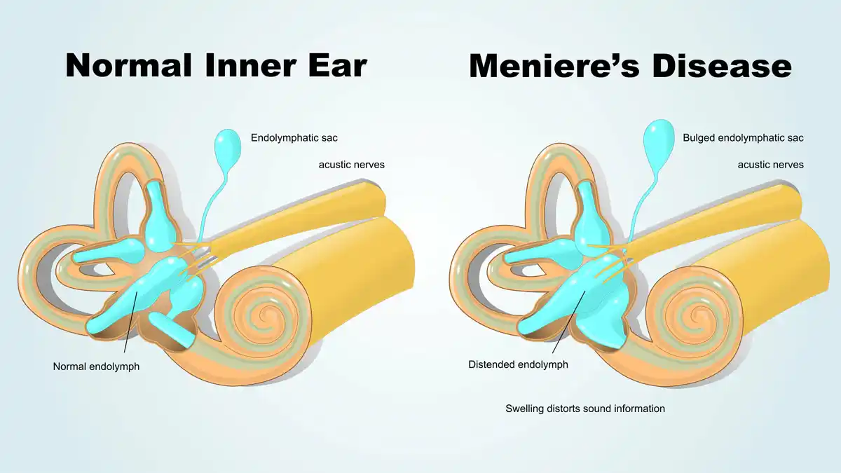 Also known as endolymphatic hydrops, Meniere’s is a disorder of balance, hearing, or both caused by an increase in endolymph, an inner-ear fluid.