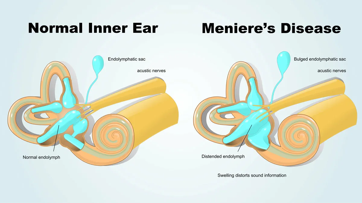 Menieres Diagram