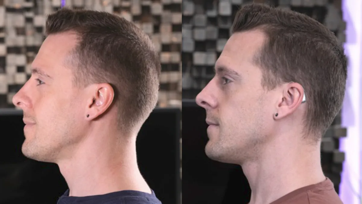 The appearance in my ears of the Starkey Edge AI (on the left) compared with the slightly larger Phonak Audéo Infinio Sphere (on the right).