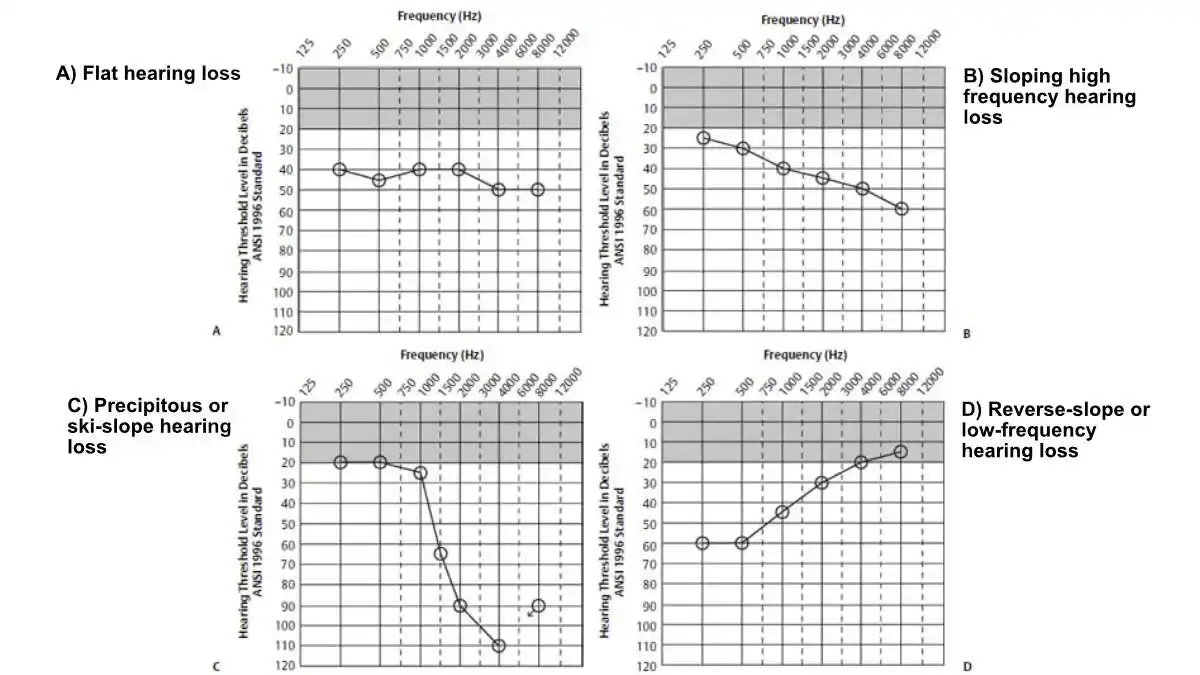 There are many different possible types of hearing loss configurations revealed by an audiogram. Four are shown above, with two common types (flat and sloping high frequency hearing loss) shown on top, and two less common types on the bottom.