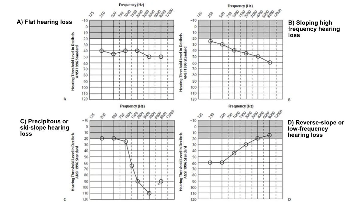 There are many different possible types of hearing loss configurations revealed by an audiogram. Four are shown above, with two common types (flat and sloping high frequency hearing loss) shown on top, and two less common types on the bottom.