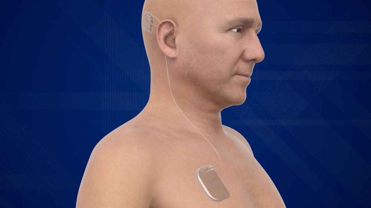 Envoy Medical Receives FDA Breakthrough Device Designation for its Fully Implanted Acclaim® Cochlear Implant