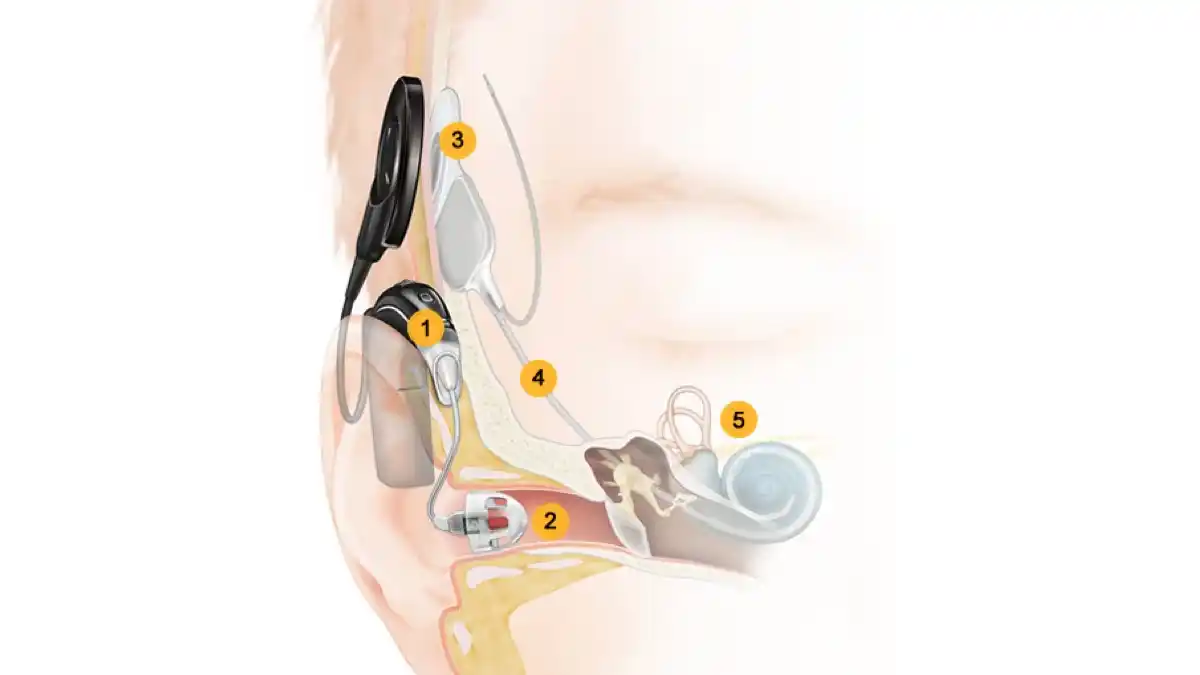 Cochlear Ltd. Hybrid Hearing System