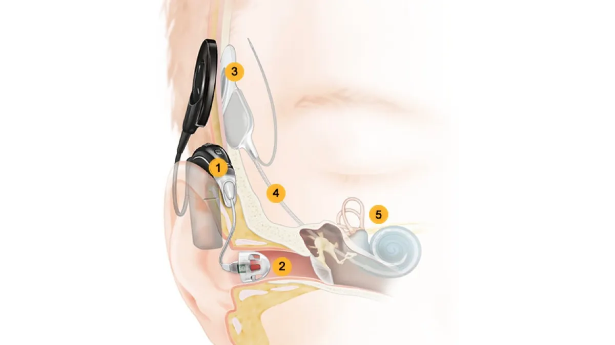 Cochlear Ltd. Hybrid Hearing System