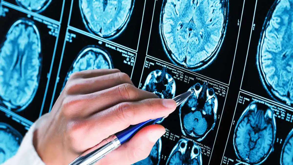 Brain Imaging Dementia