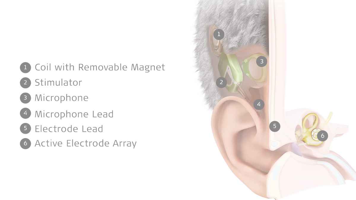 MED-EL Launches TICI UNICO, First Fully Implantable Cochlear Implant
