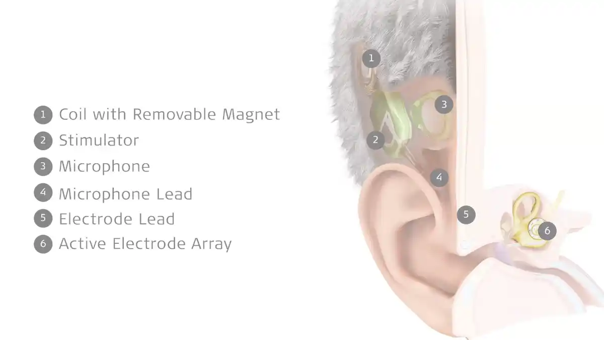 Components of the MED-EL TICI UNICO fully implantable cochlear implant. The rechargeable battery is located within the stimulator.