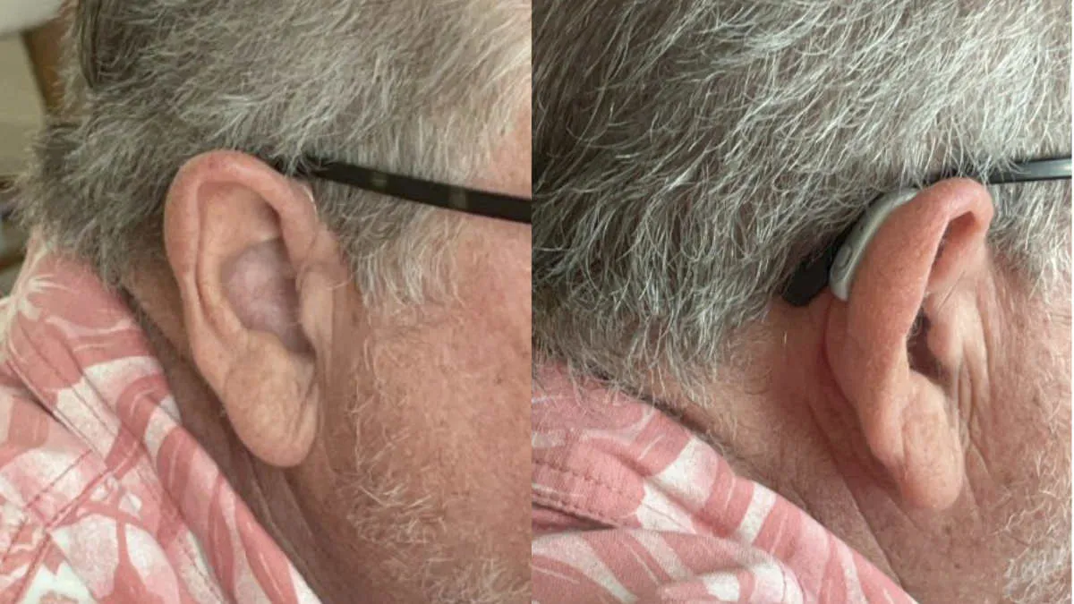 How Jabra Enhance Select 500 hearing aids look on my ears from side and back.