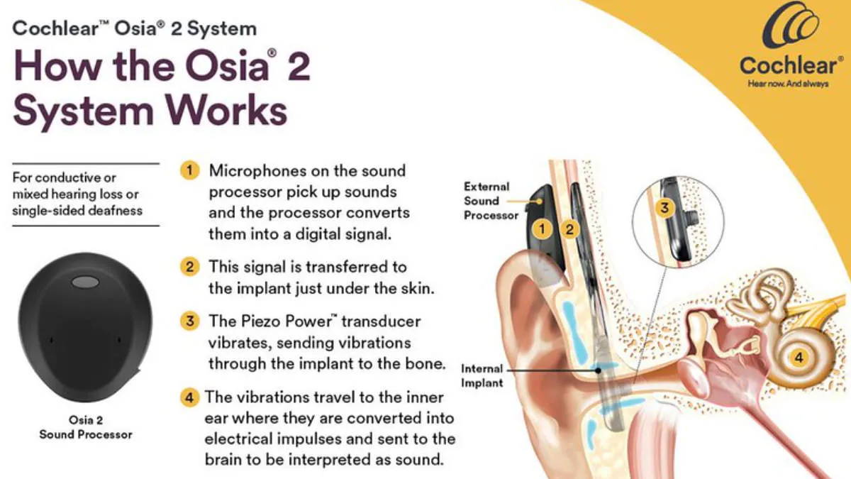 Explanation of the Osia 2 bone conduction implant system.