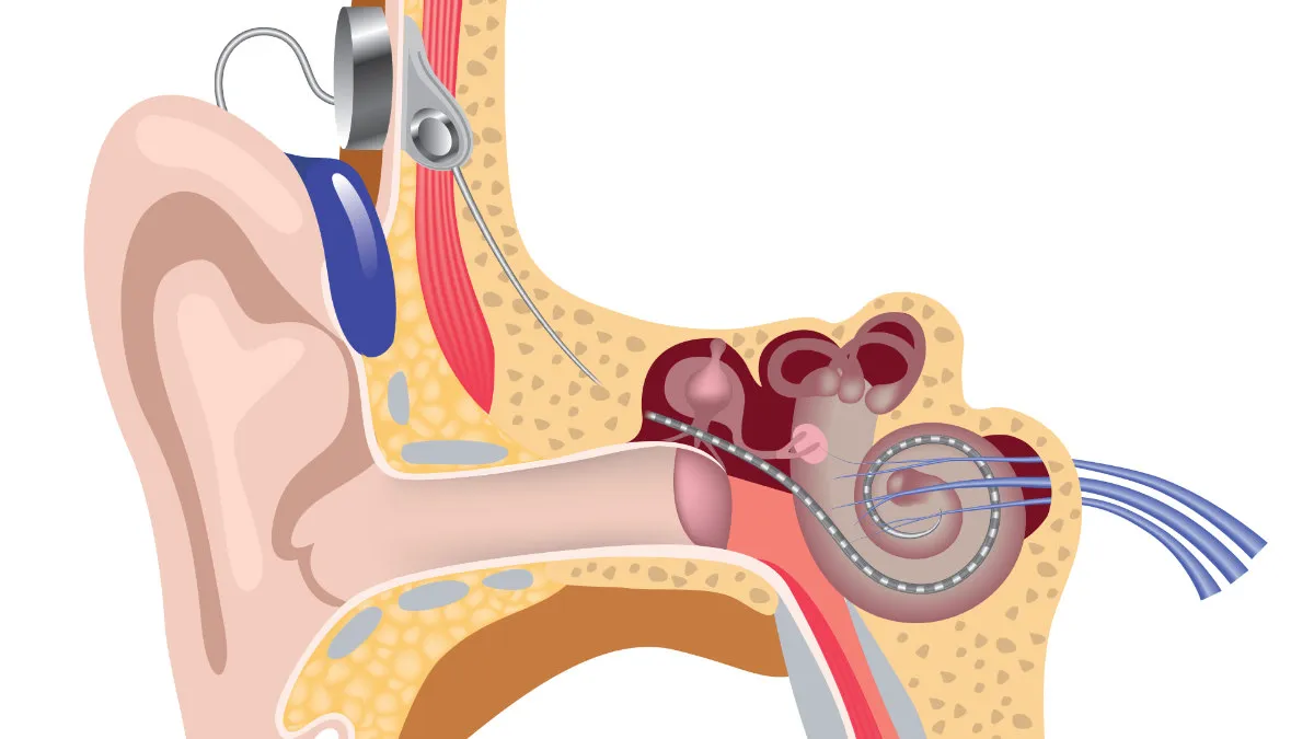 Cochlear implants receive sound through a hearing-aid-like processor on the ear and relay them via electrical signals directly to the nerves inside the spiral-shaped cochlea, effectively bypassing damaged portions of the ear. 