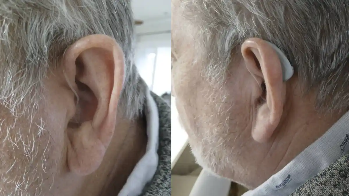 A closeup photo of how the JVC EH-Z1500 hearing aid looks on my ear.