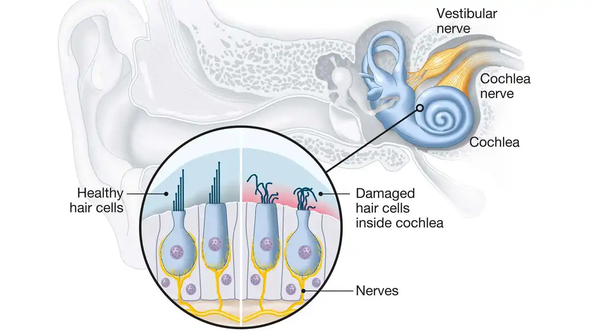 Sensorineural hearing loss, or SNHL, happens after damage to the hair cells within your inner ear (cochlea) or the nerve pathways from your inner ear to your brain.