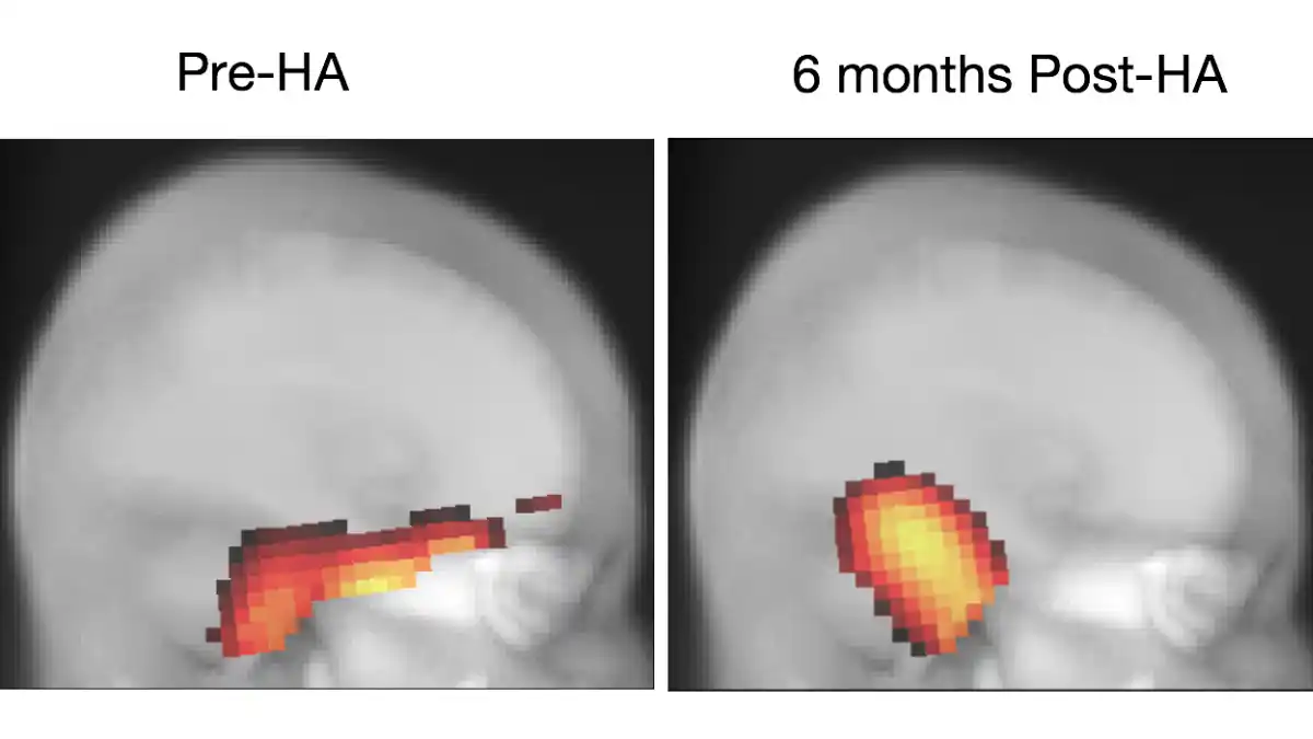 Two comparison images of brain site activation in a person with hearing loss in response to a visual motion stimulus. In the left image, before the use of hearing aids, the brain's vision center has compensated for the hearing loss by recruiting areas typically used for hearing (i.e., "cross-modal recruitment”). In the right image, after 6 months of hearing aid use, a reversal of this recruitment has occurred, resulting in a more typical brain activation. Image from the research of Hannah Glick and Anu Sharma at the University of Colorado-Boulder. Courtesy of The Hearing Review.