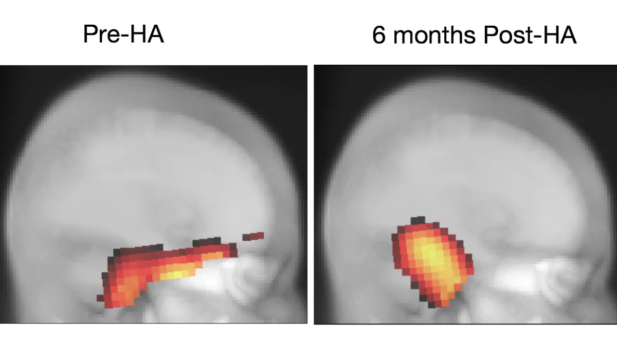 Two comparison images of brain site activation in a person with hearing loss in response to a visual motion stimulus. In the left image, before the use of hearing aids, the brain's vision center has compensated for the hearing loss by recruiting areas typically used for hearing (i.e., "cross-modal recruitment”). In the right image, after 6 months of hearing aid use, a reversal of this recruitment has occurred, resulting in a more typical brain activation. Image from the research of Hannah Glick and Anu Sharma at the University of Colorado-Boulder. Courtesy of The Hearing Review.