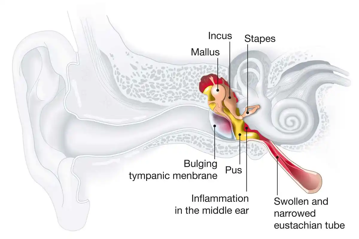 Middle ear infection or otitis media.