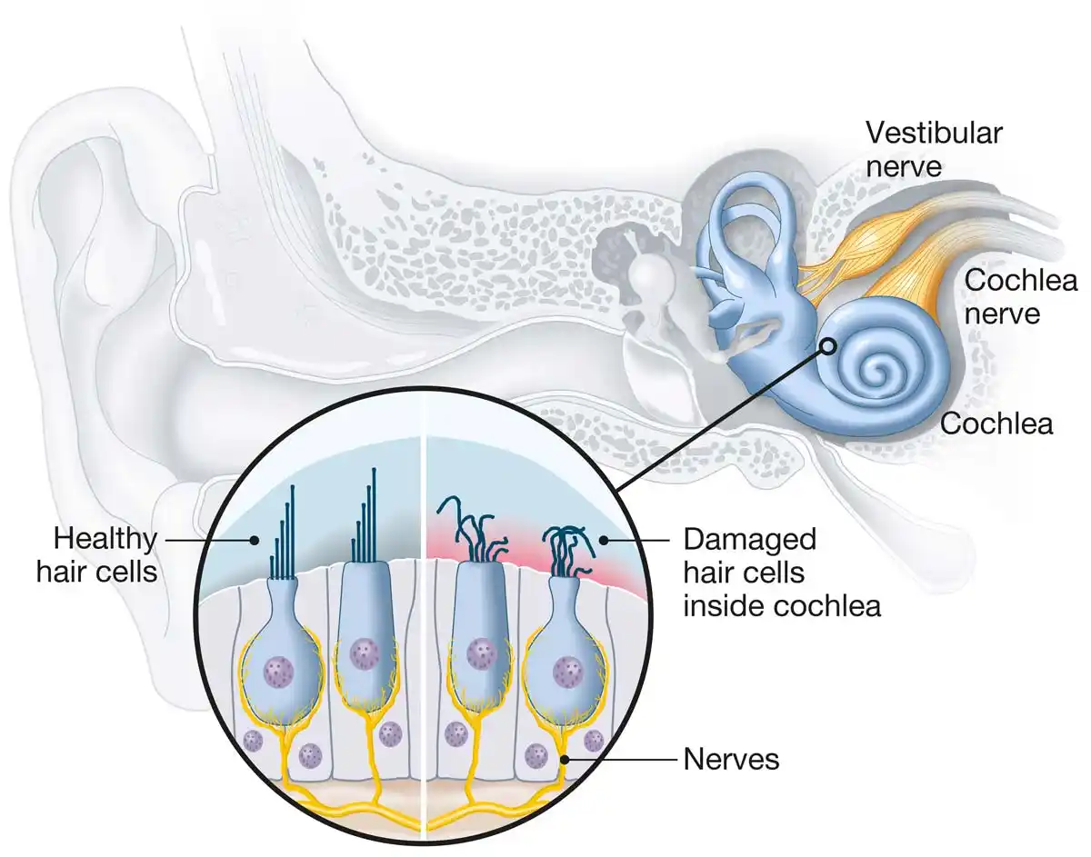 Sensorineural hearing loss