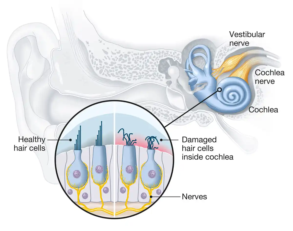 Damaged inner ear hair cells