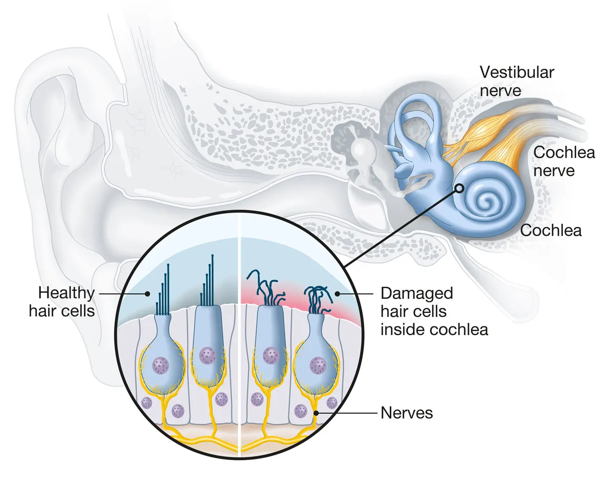 Inner-ear hair cells are responsible for converting mechanical vibrations into electrical signals that are then relayed to the brain. Up to 30% to 50% of hair cells can be damaged or destroyed before changes in your hearing can be measured by a hearing test. But when they're gone, they're gone—at least until some researchers find a new treatment.