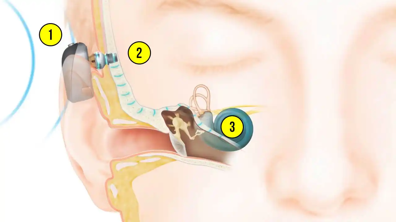 The Cochlear Baha system uses a small abutment to provide a direct connection between the implant and sound processor, which is designed to maximize your hearing performance. The way the system works is: 1) The Baha 6 Max Sound Processor picks up sound vibrations from the environment; 2) The sound vibrations are transferred through an abutment to a small titanium implant inserted in the bone behind the ear; 3) Sound vibrations are then sent directly through the bone to the inner ear (cochlea) which transfers the signals to the brain, allowing you to perceive sound naturally.