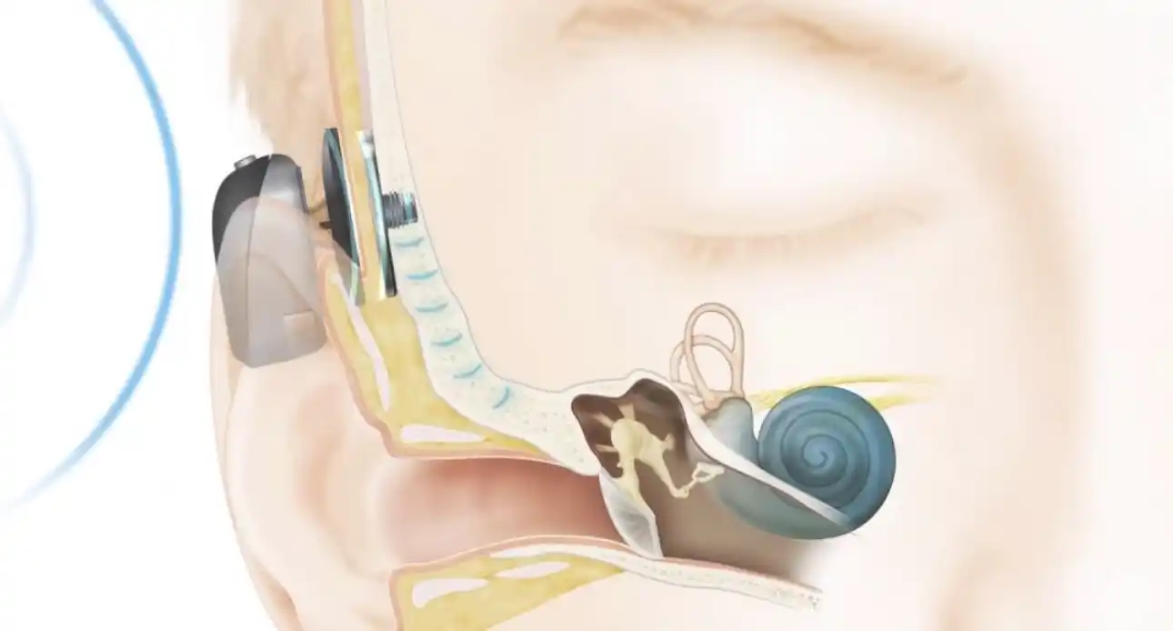 A bone anchored hearing aid (BAHA) works by transmitting sound vibrations directly through the skull bone to the inner ear, bypassing the outer and middle ear.