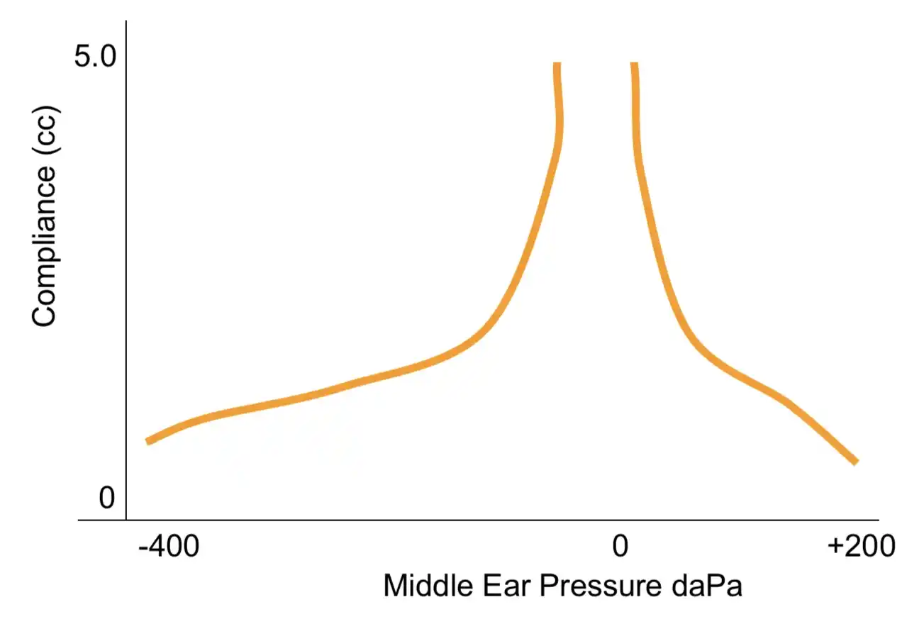 Type Ad tympanograms are typically seen when the eardrum is "hypermobile".