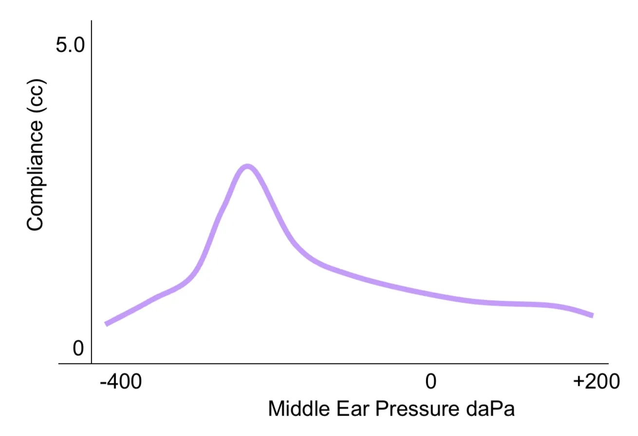 Type C tympanograms are typically seen in cases of congestion and abnormal eustachian tube function.