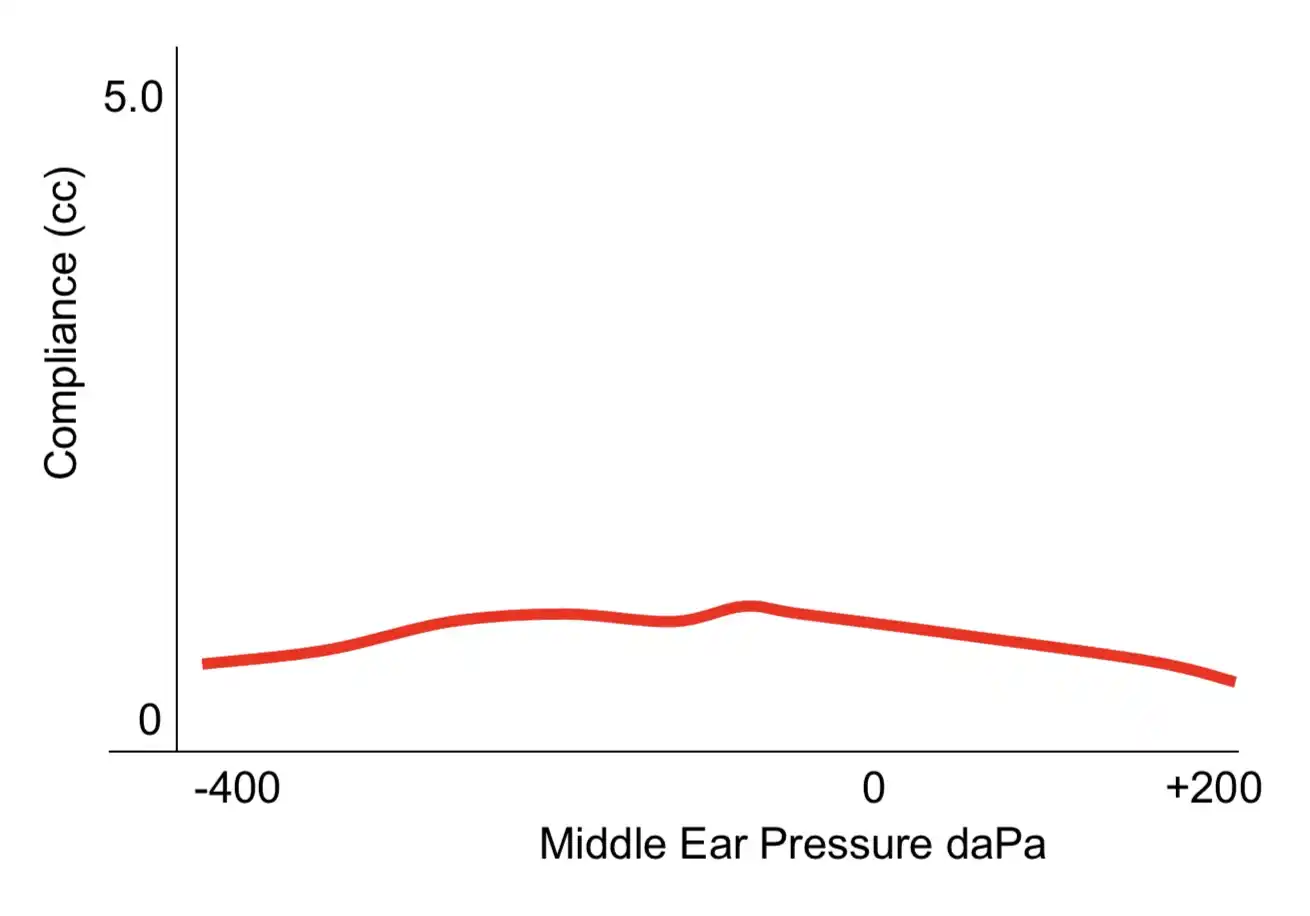 Type B tympanograms are typically seen in cases of middle ear infections.
