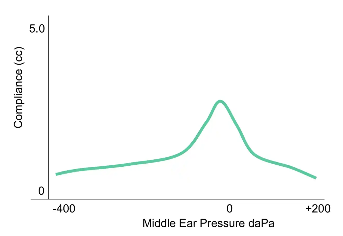Type A tympanograms are typically seen in normally functioning ears.