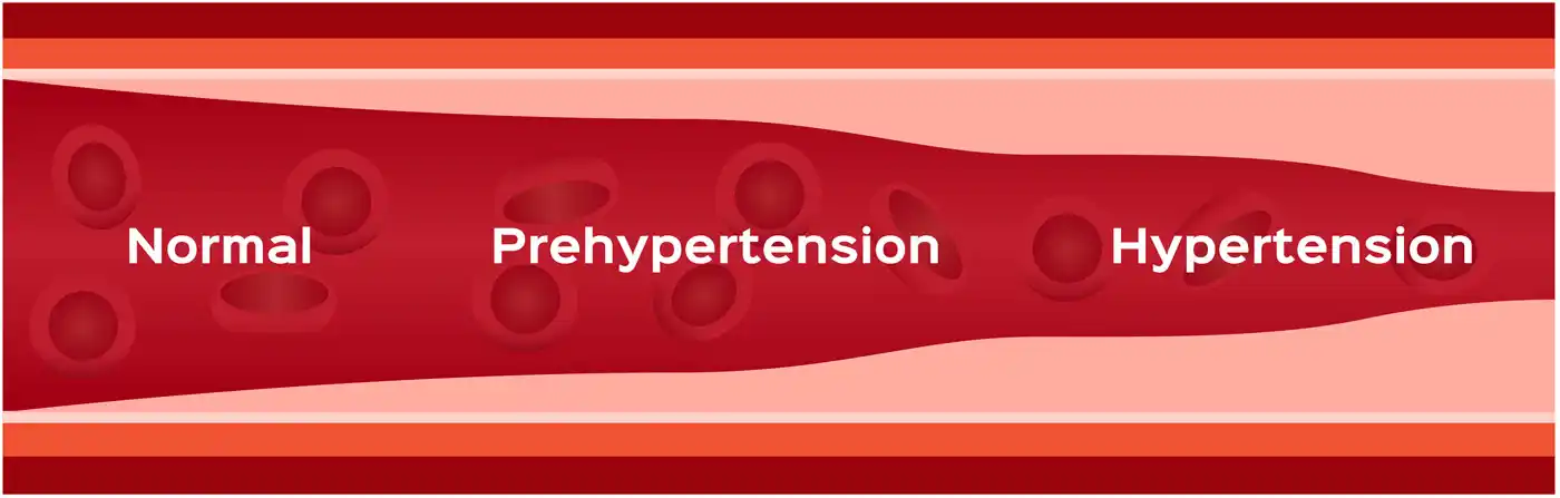 In hypertension, arteries become constricted, forcing the heart to pump blood with more force. 