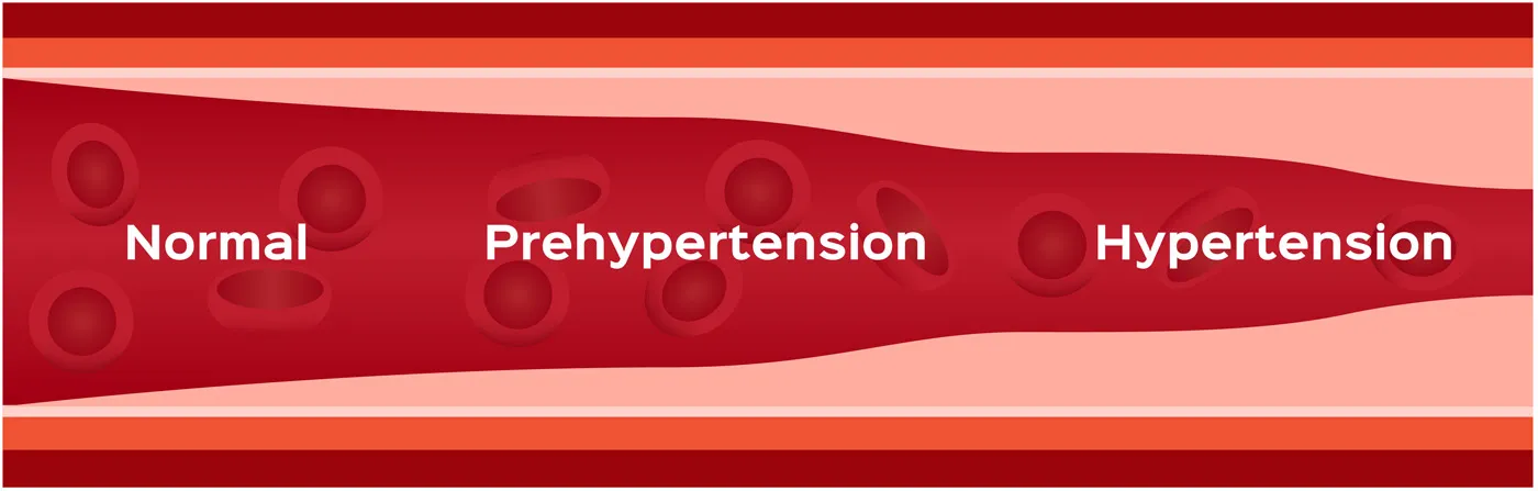 In hypertension, arteries become constricted, forcing the heart to pump blood with more force. 
