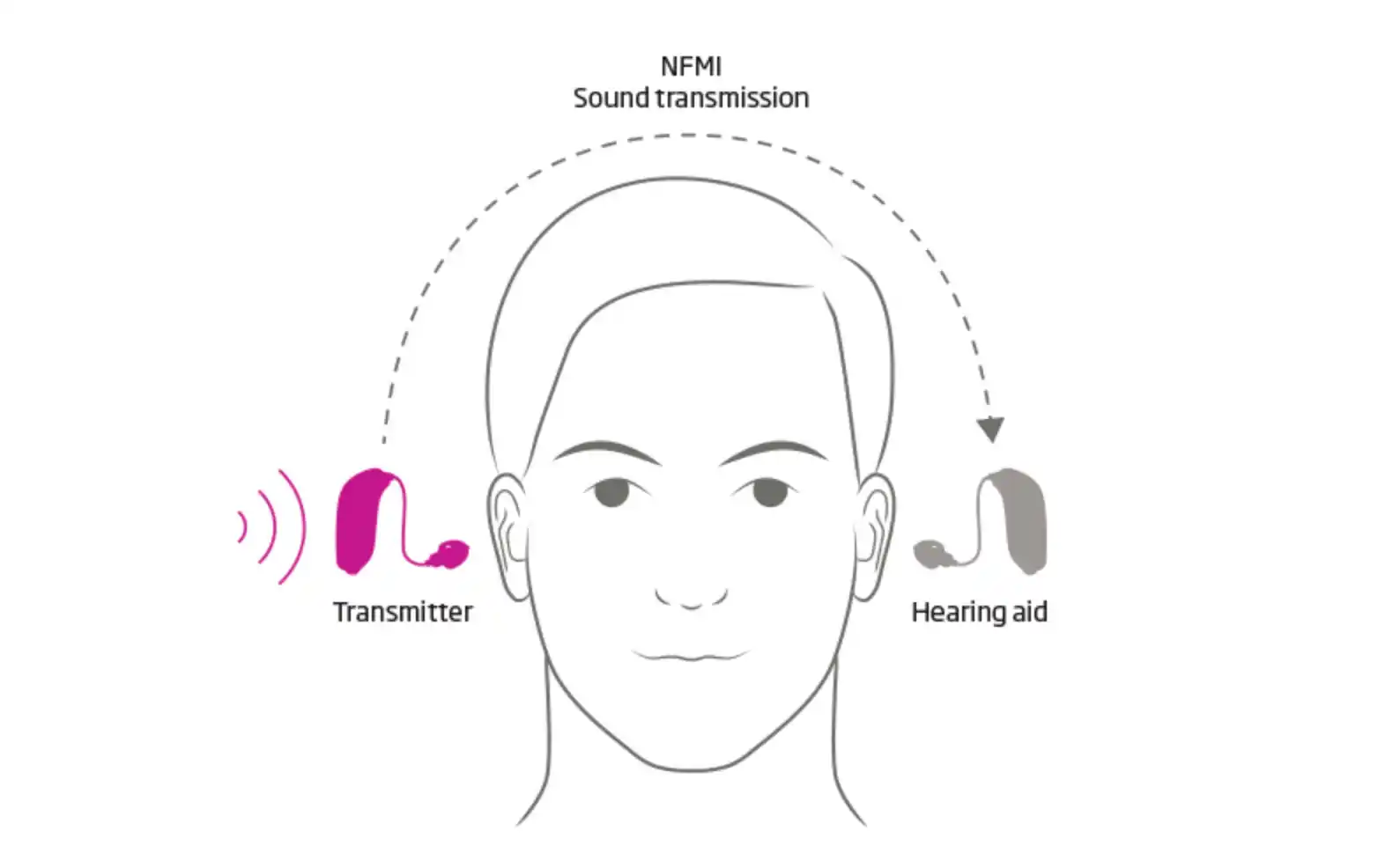 A CROS hearing aid system consists of a transmitter on the poorer-hearing ear which transmits sound to a hearing aid on the other better-hearing ear. In this way, you gain hearing on both sides of the head, which is important for conversation and environmental awareness. When amplification is needed in the better ear, then the hearing aid also amplifies sound on that side, making it a BiCROS system. Illustration courtesy of Oticon.