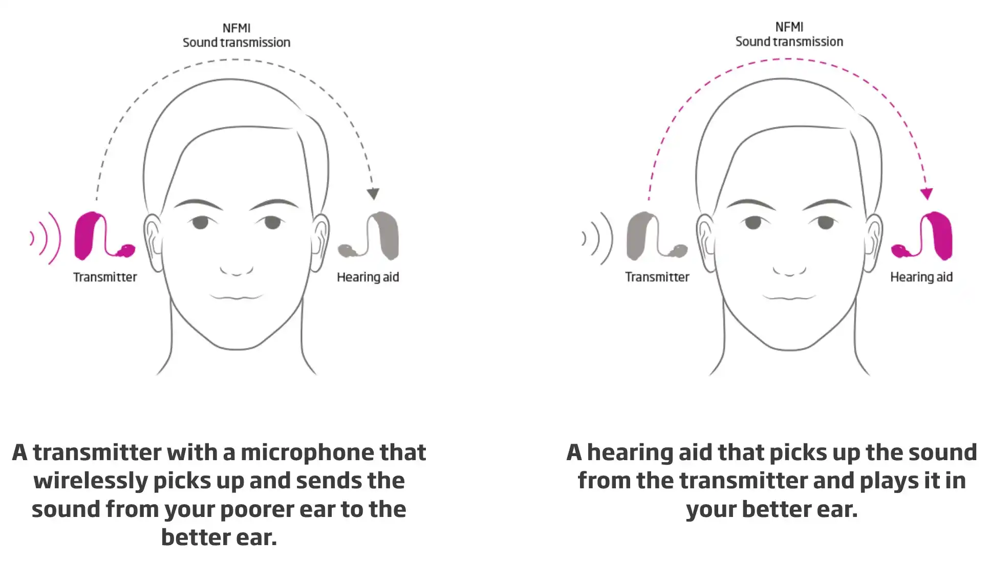 If you have single-sided deafness where there is significant or total hearing loss in one ear, the Oticon CROS family can help you overcome challenges by streaming sound from the poorer-hearing ear to the better ear.