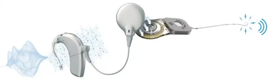 Advanced Bionics Technology System