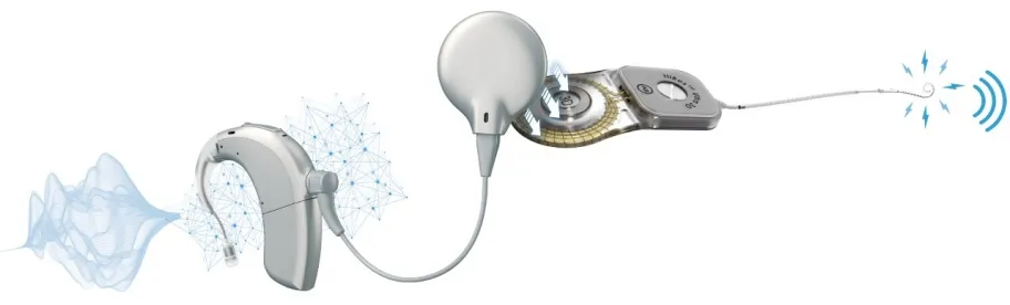 Advanced Bionics Technology System