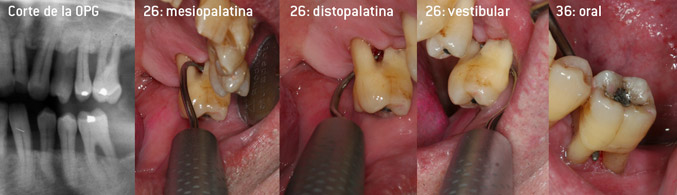 Desbridamiento cerrado de las furcaciones de las piezas 26 y 36 